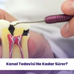 Kanal tedavisi nedir ve ne kadar sürer öğrenmeye hazır olun.