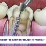 Kanal tedavisi sonrası ağrı normal mi? Aliadent ile öğrenin.