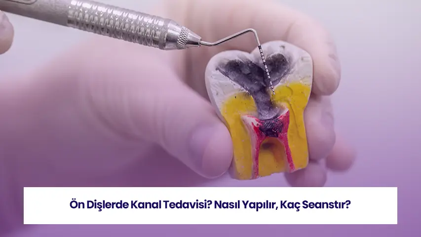 Ön Dişlerde Kanal Tedavisi? Nasıl Yapılır, Kaç Seanstır? 6 Ön diş kanal tedavisi işlemine dair içeriğimize göz atın!