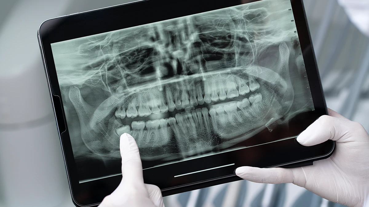 yirmilik dis apsesi hakkinda bilgi