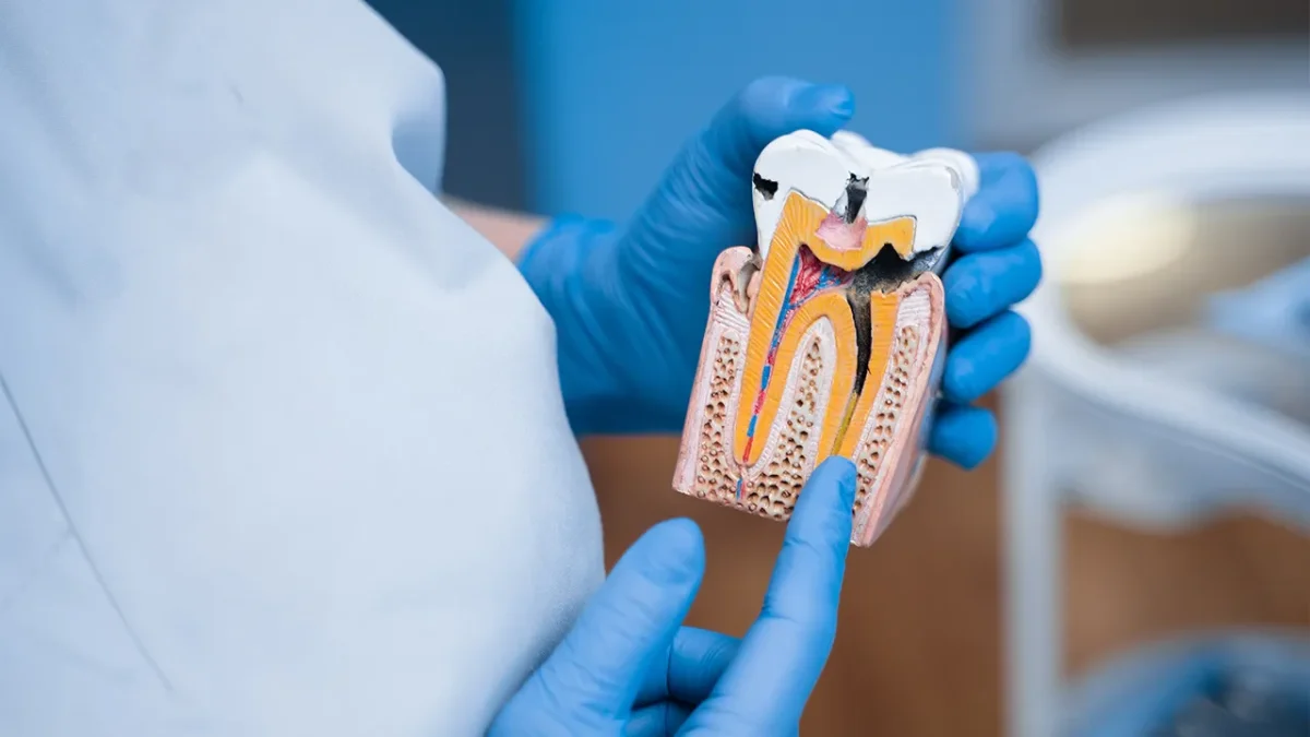 Diş Dolgusu Hakkında En Çok Sorulan 10 Soruyu Yanıtlıyoruz 5 dolgudan sonra yemek yenir mi