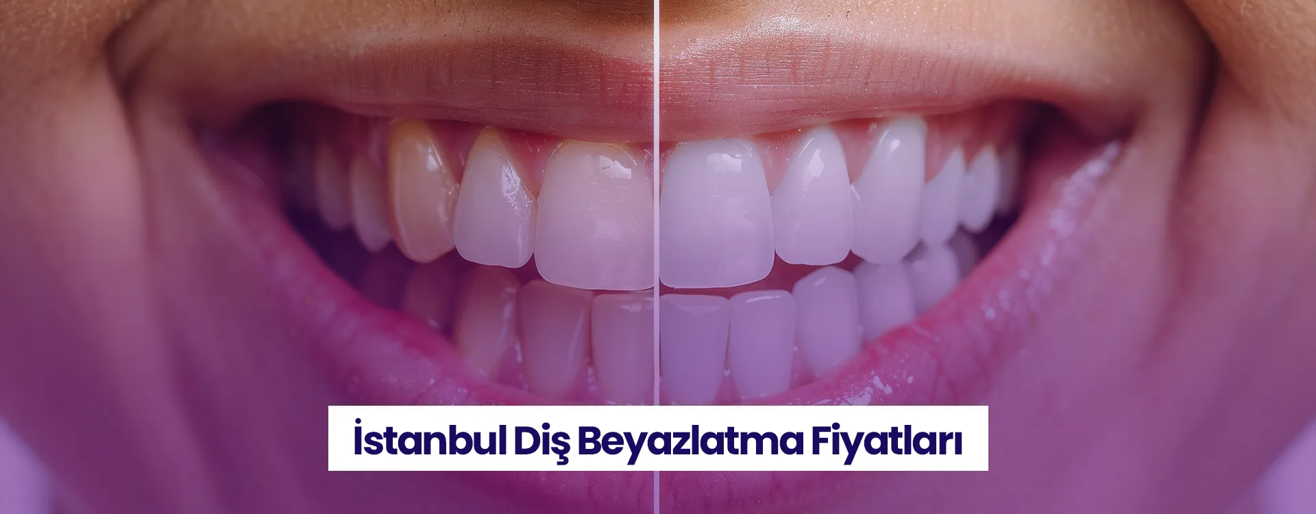 2026 diş beyazlatma fiyatları İstanbul klinikleri arasında yüz güldüren seçeneklerle şekilleniyor.