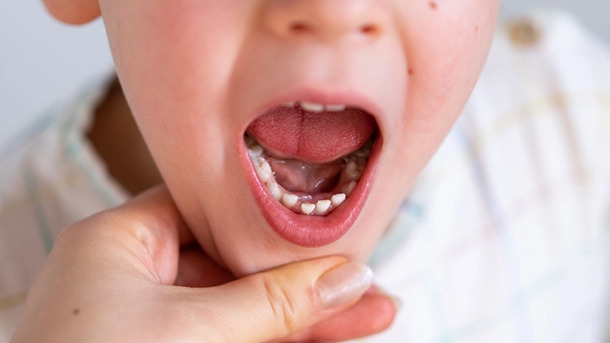 cocuklarda alttan yeni dis cikmasi