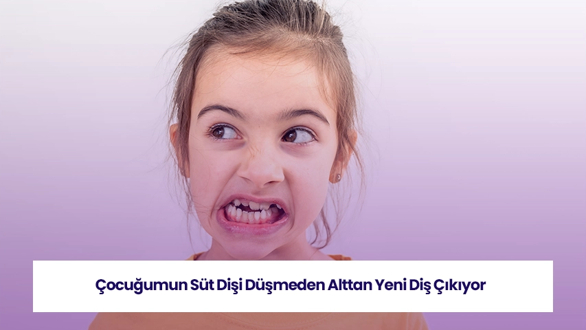 Süt dişi düşmeden kalıcı diş çıkması, çocuk diş gelişiminde görülen bir durumu açıklar.