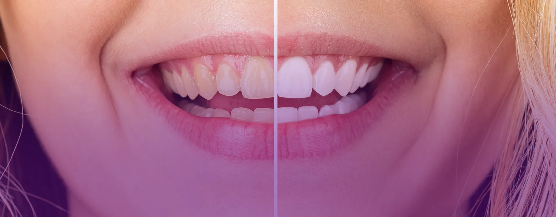 Tek seansta diş beyazlatmaya dair bir görsel.