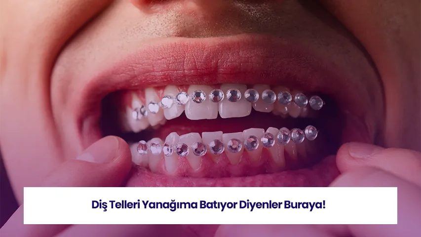 Diş teli batması durumunu ve oluşabilecek rahatsızlığı açıklayan görsel.