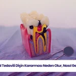 Kanal tedavili dişin kararması sürecini anlatan görsel.