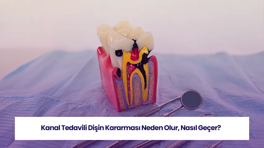 Kanal tedavili dişin kararması sürecini anlatan görsel.