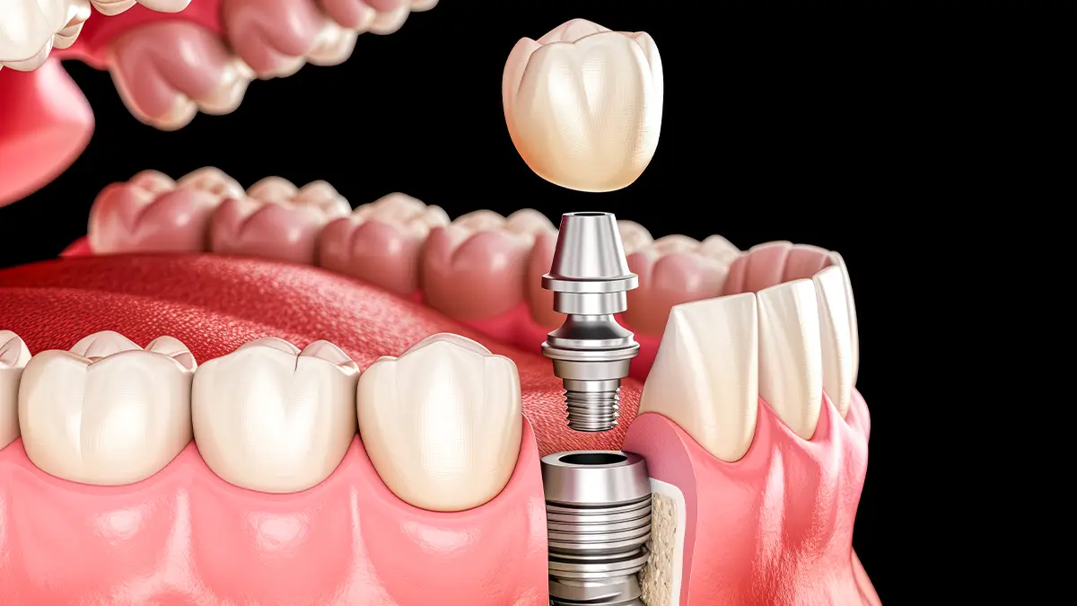 İmplant Sonrası Şişlik Kaç Gün Sürer? 6 implant sonrasi agri hakkinda bilgiler