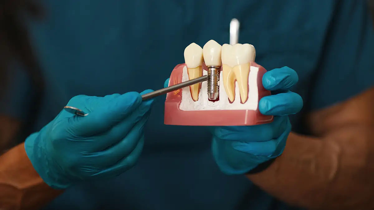İmplant Sonrası Şişlik Kaç Gün Sürer? 7 implant sonrasi bakim nasil yapilmalidir
