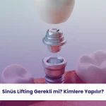 Sinüs Lifting Gerekli mi? Kimlere Yapılır? 2 Sinüs lifting gerekli mi sorusu, implant tedavisi öncesi kemik yeterliliğini değerlendirir.
