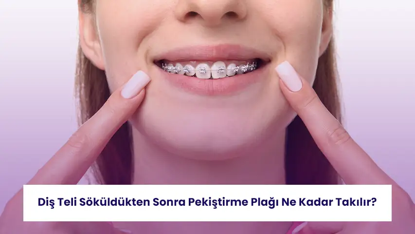 Diş Teli Söküldükten Sonra Pekiştirme Plağı Ne Kadar Takılır? 9 Diş teli söküldükten sonra retainer kullanımı ve nüks riskleri hakkında bilgilendirme görseli.
