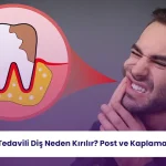Kanal Tedavili Diş Neden Kırılır? Post ve Kaplama Kararı 2 Kanal tedavili dişlerde kırık riski ve doğru restorasyon seçimi hakkında önemli bilgiler.