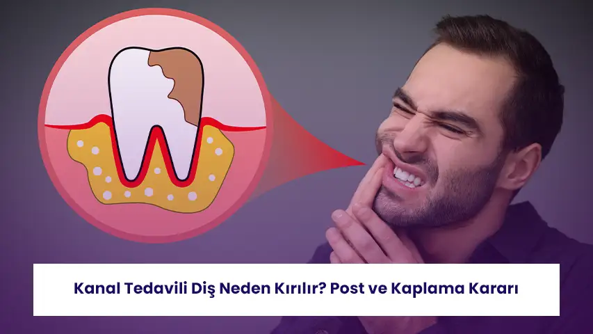 Kanal Tedavili Diş Neden Kırılır? Post ve Kaplama Kararı 7 Kanal tedavili dişlerde kırık riski ve doğru restorasyon seçimi hakkında önemli bilgiler.