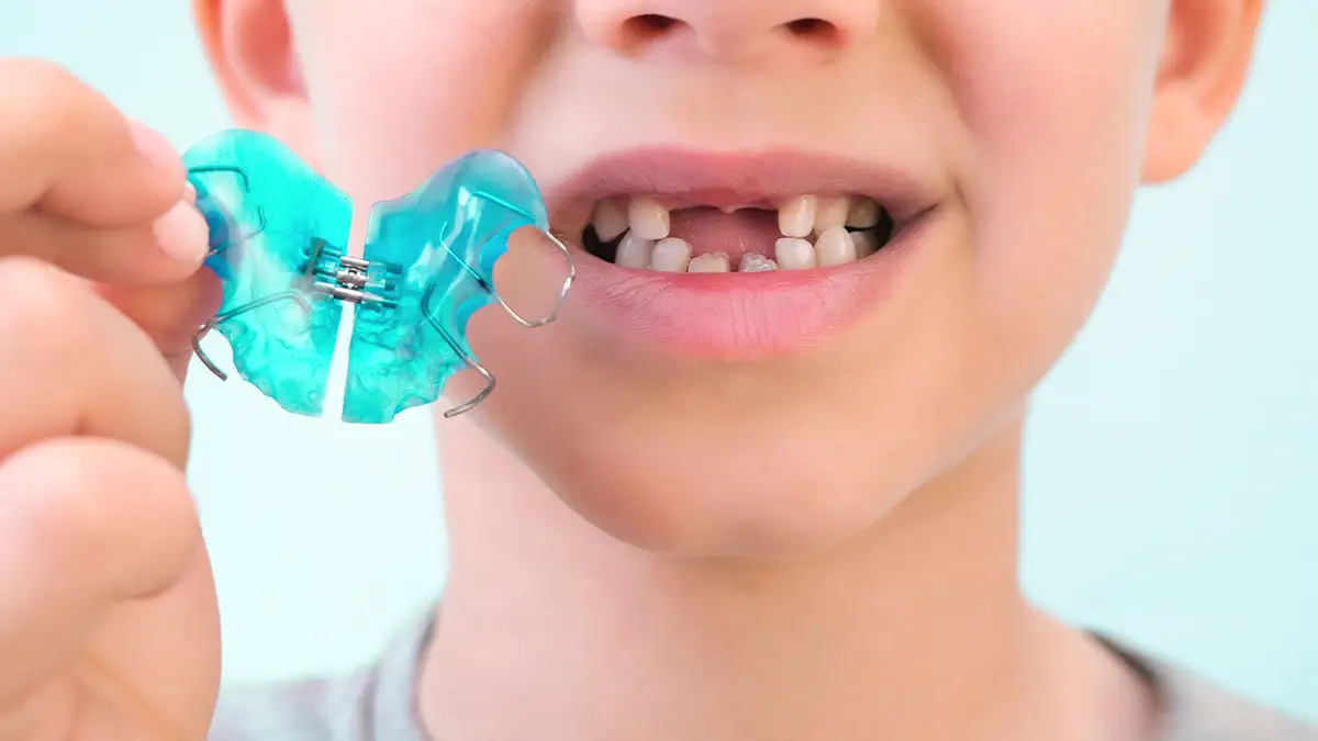 Diş Teli Söküldükten Sonra Pekiştirme Plağı Ne Kadar Takılır? 7 seffaf retainer plak ile duzgun gulusun uzun sure korunmasi